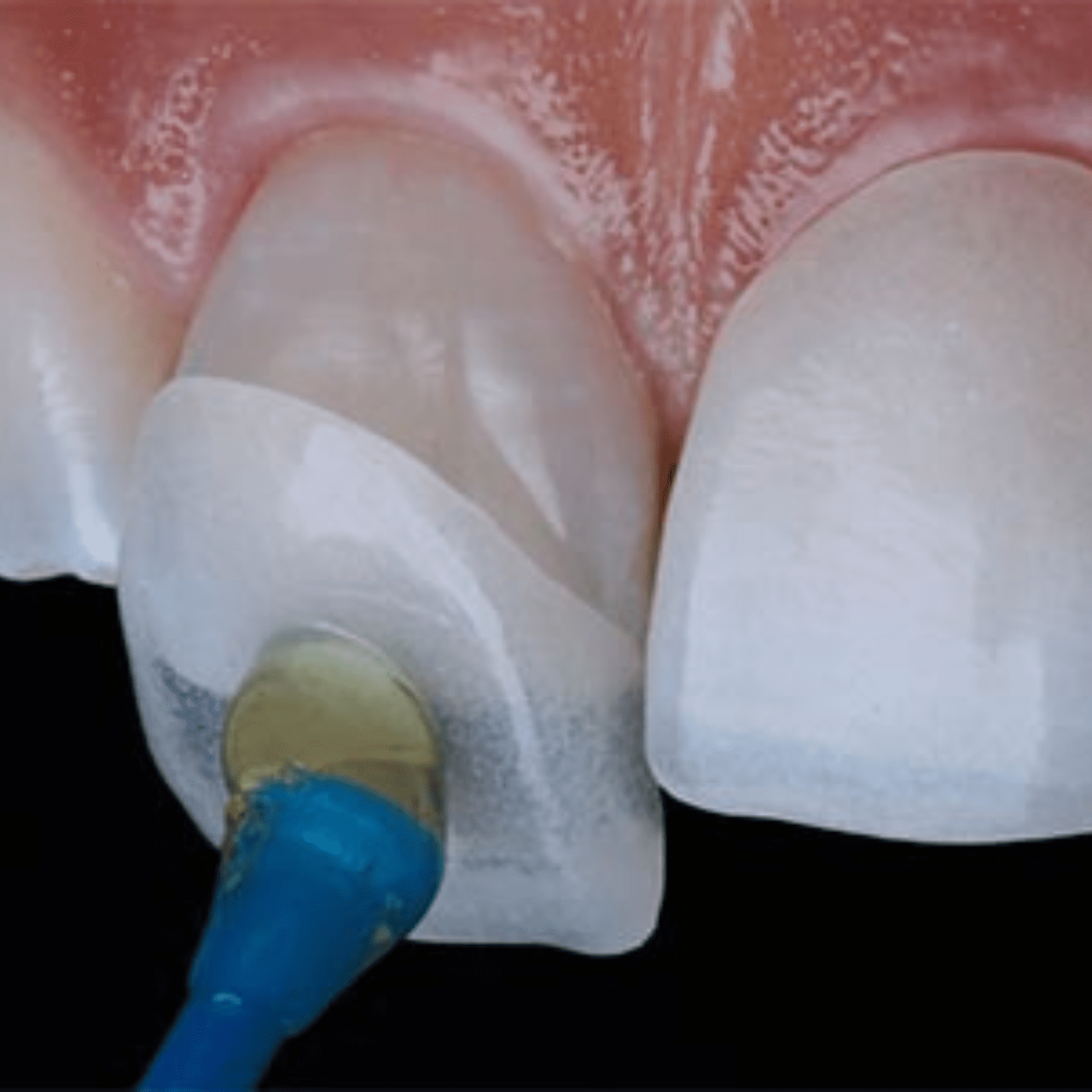Placing a veneer on a tooth.