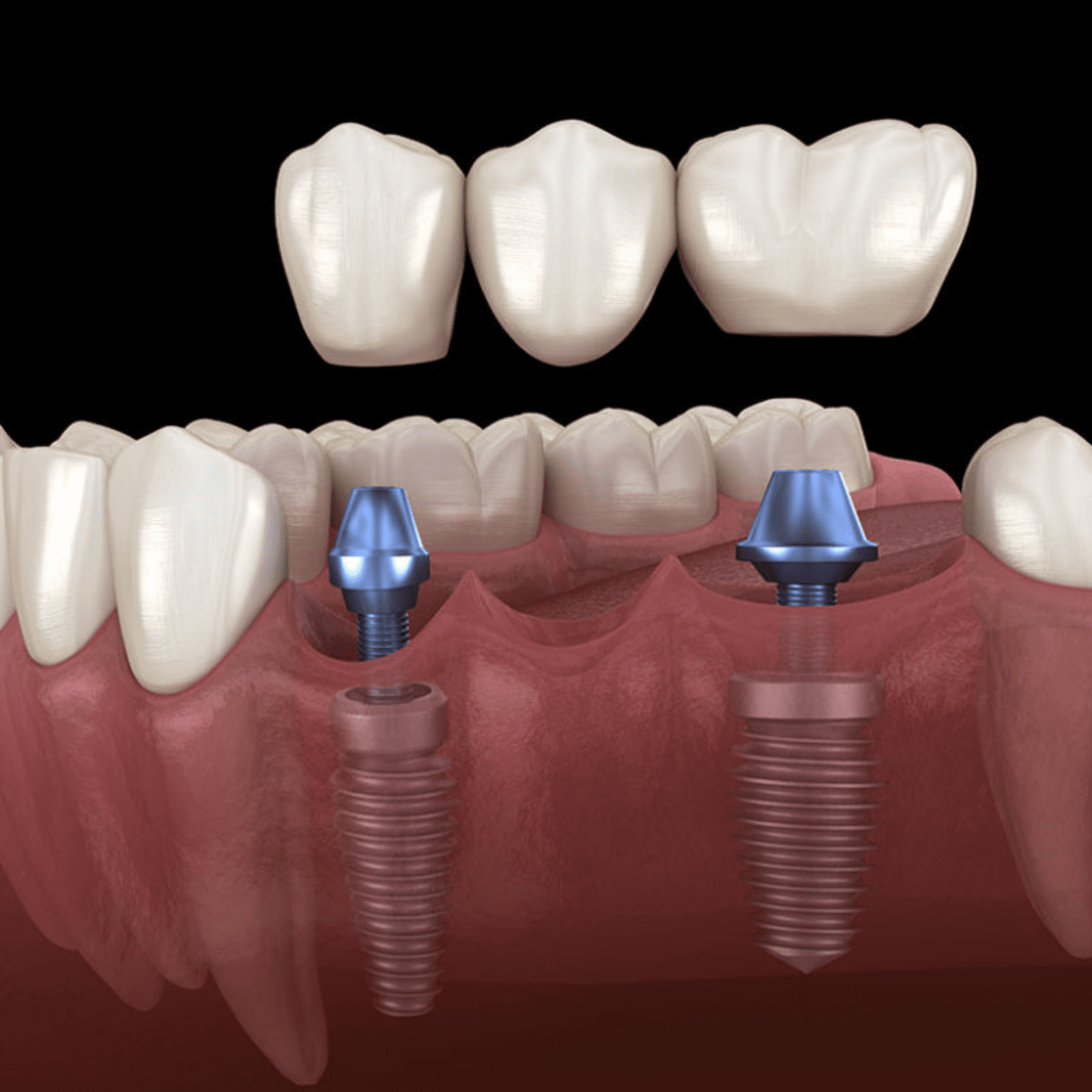 Exploring Dental Implants: Types and Their Benefits