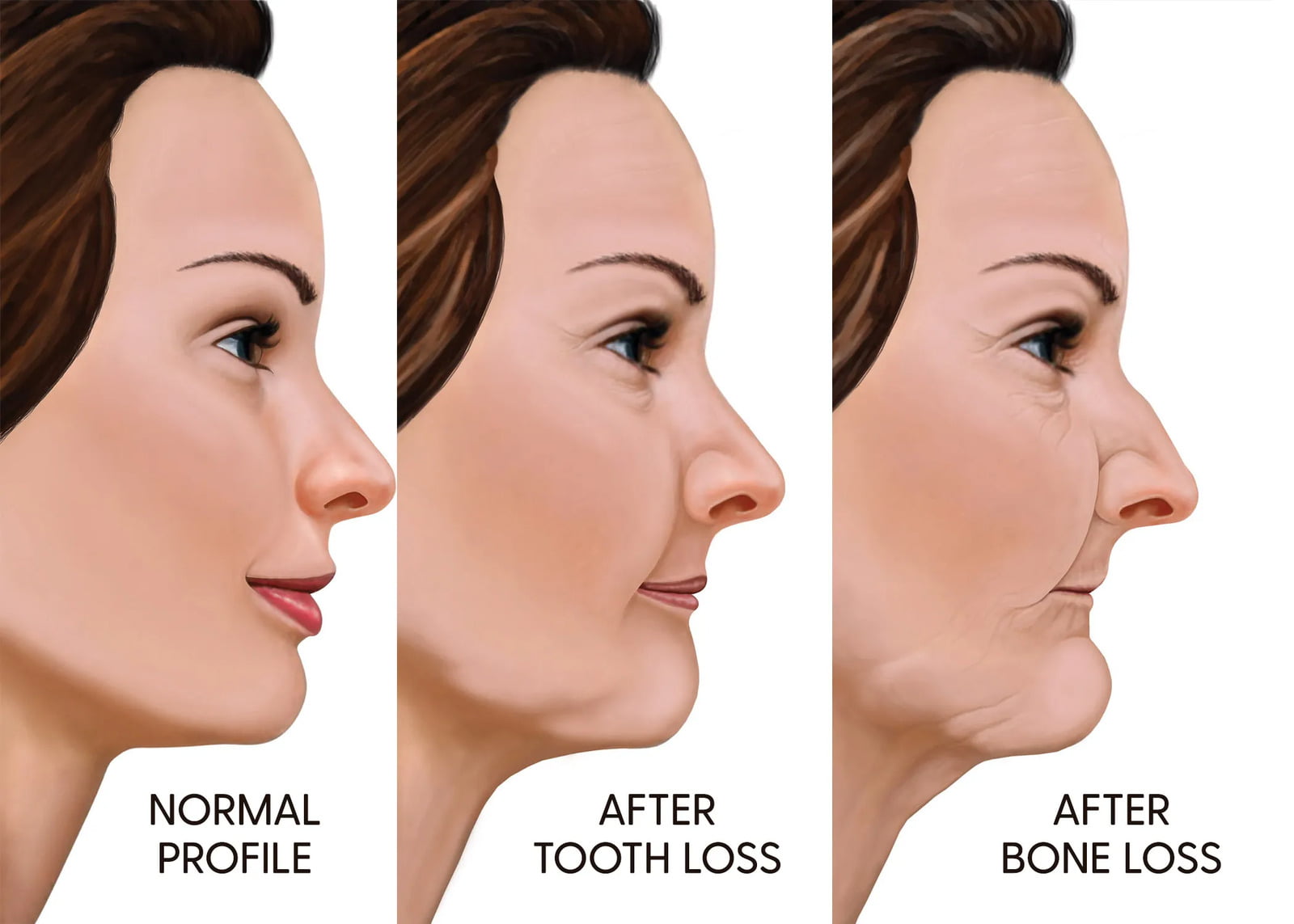 Lateral profile of a woman in 3 phases based on bone quantity.