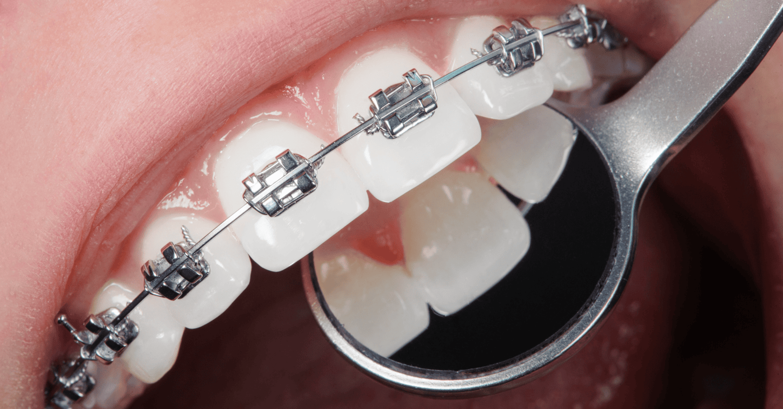Smile with self-ligating braces for a comfortable and efficient teeth alignment treatment.
