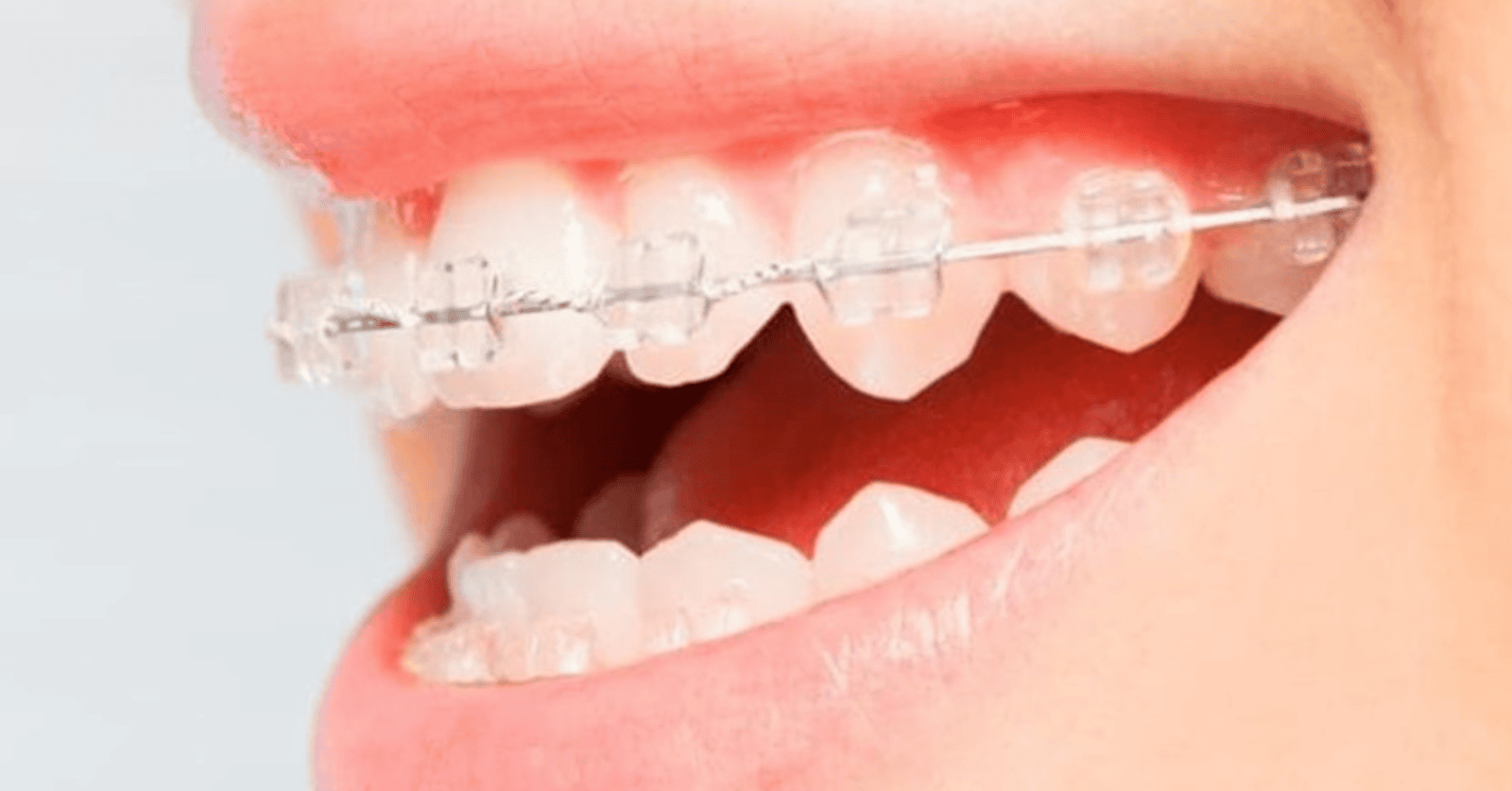 Smile with ceramic self-ligating braces for a discreet and effective teeth alignment treatment.