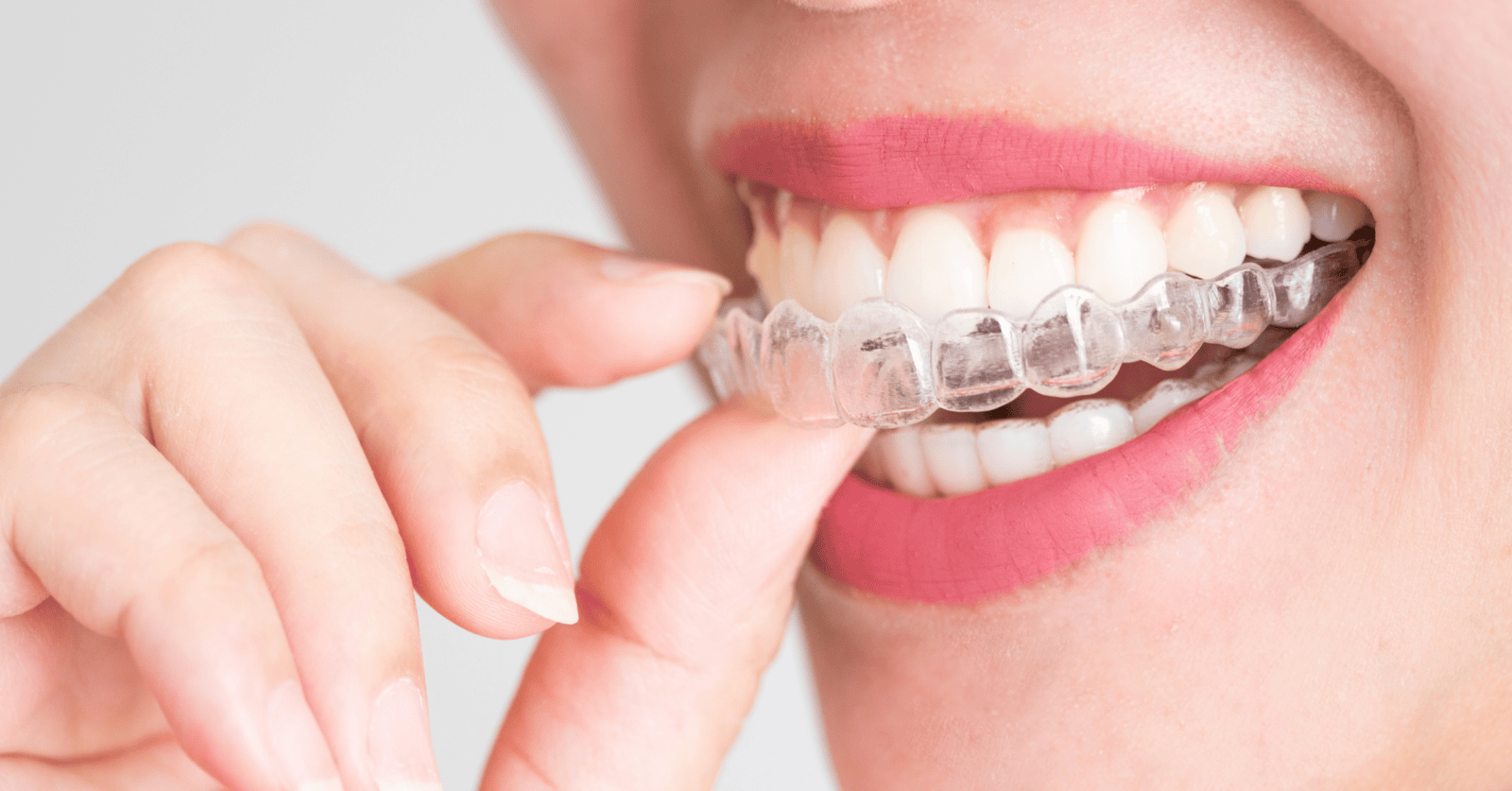 Invisalign Clear Aligners Cima Oral Surgery