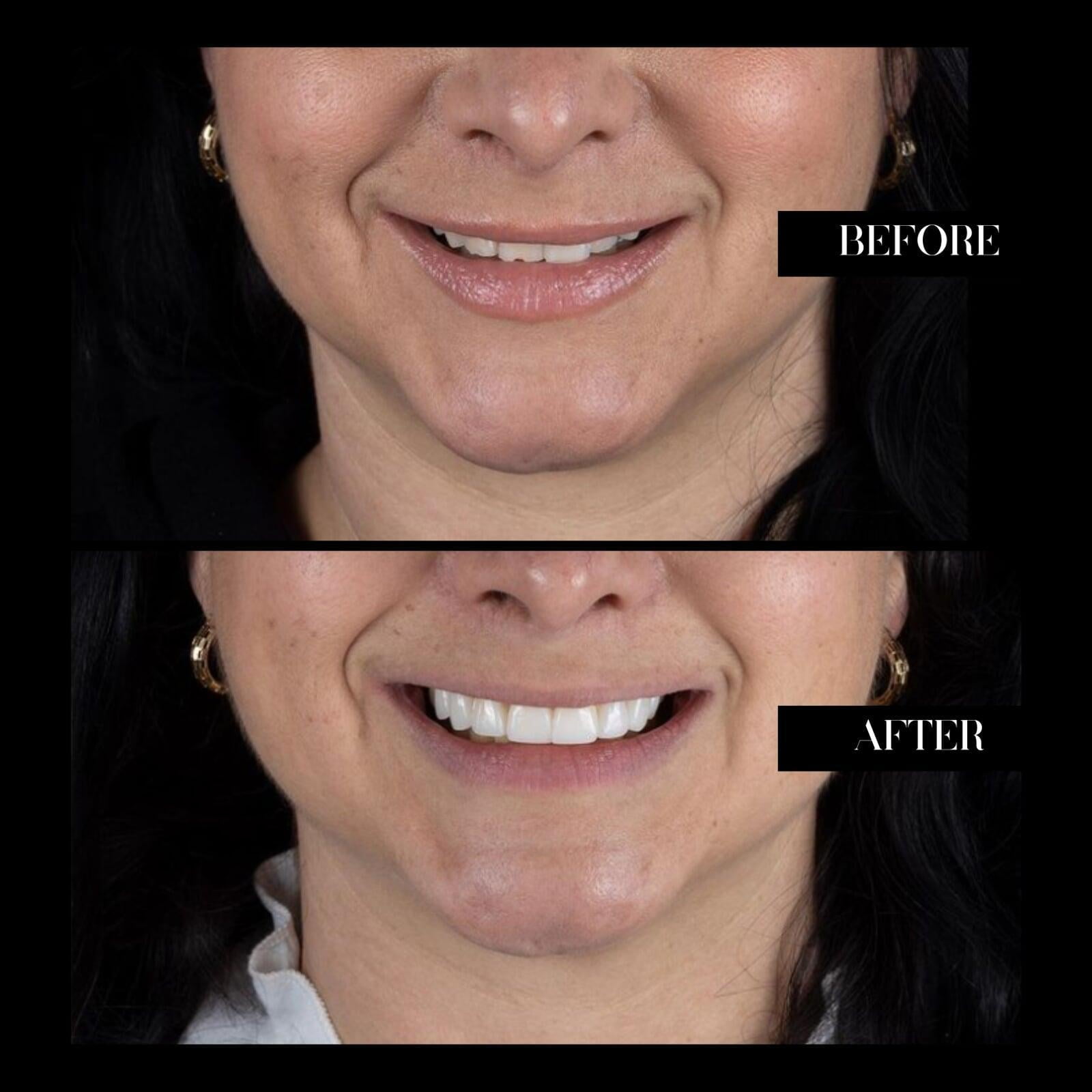 Smile Before and Afther Woman Smile Spa Tijuana