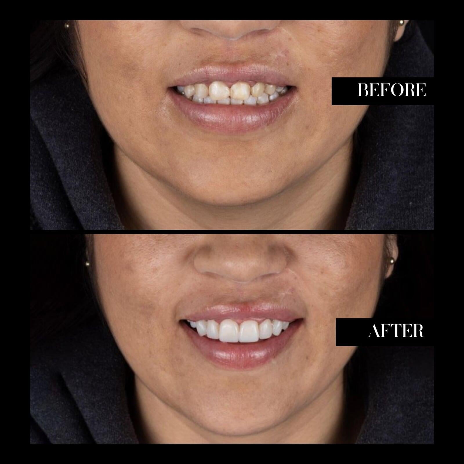 Smile Before and Afther Woman Tijuana