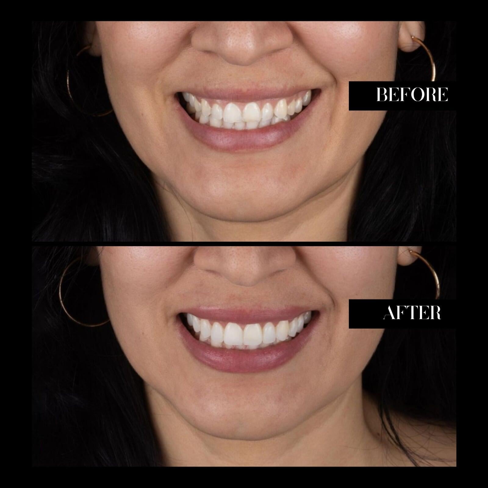 Smile Before and Afther Woman
