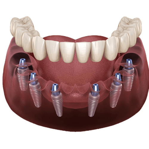 Full arch on 6 implants in an all-on-6 procedure.