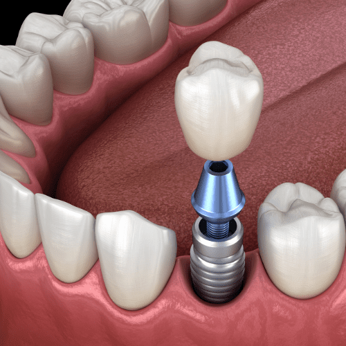 Dental implant placement with a Zirconia crown.
