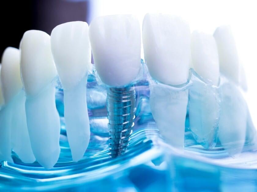 Dental implant on a blue-colored prosthesis.