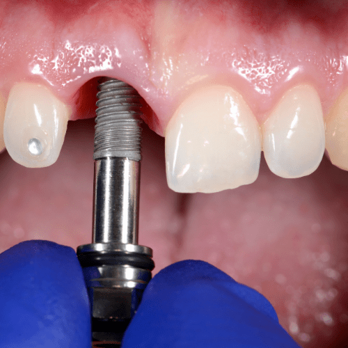 Dental implant placement in front teeth.