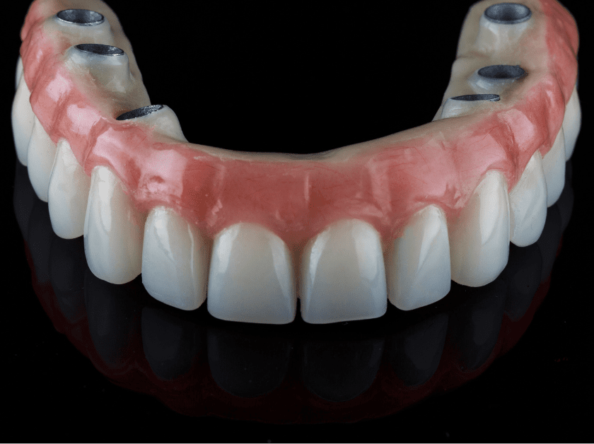 Complete arch prosthesis for all on 6.