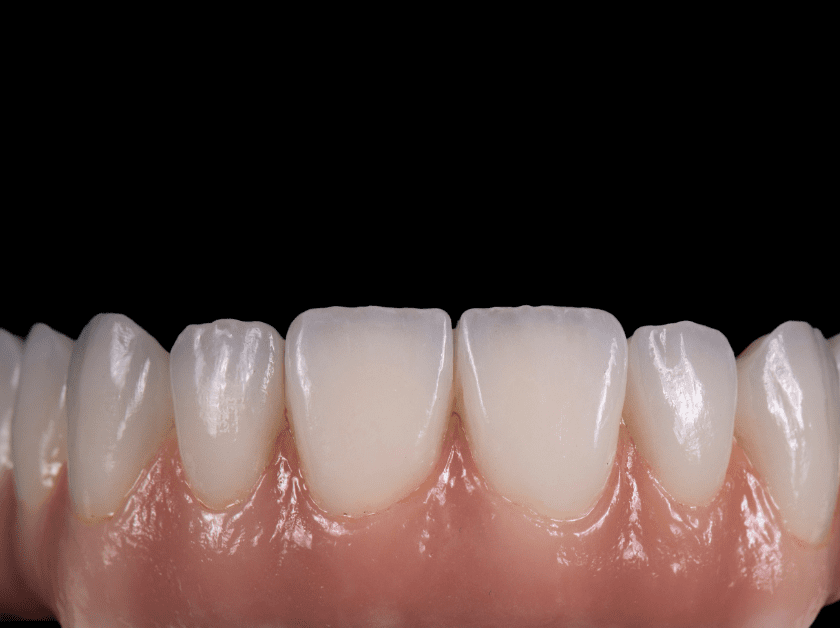 Fixed arch of teeth in a prosthesis.