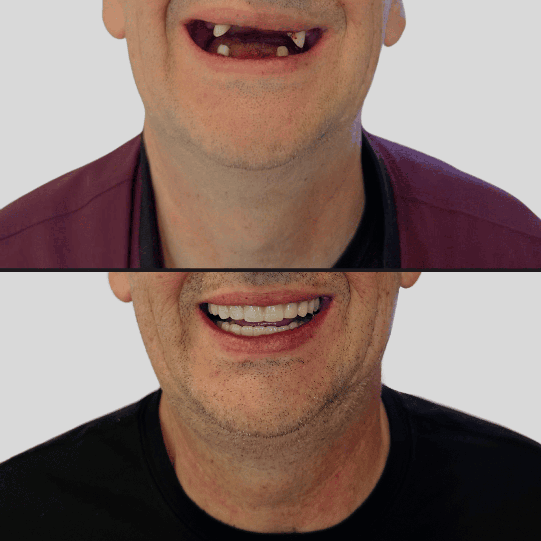 Snap-on dentures on implants.