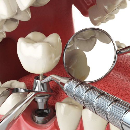 Dental implant placement.