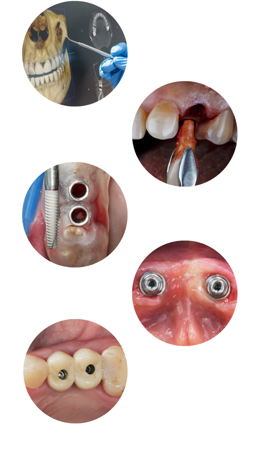 Phases of the dental implant process.