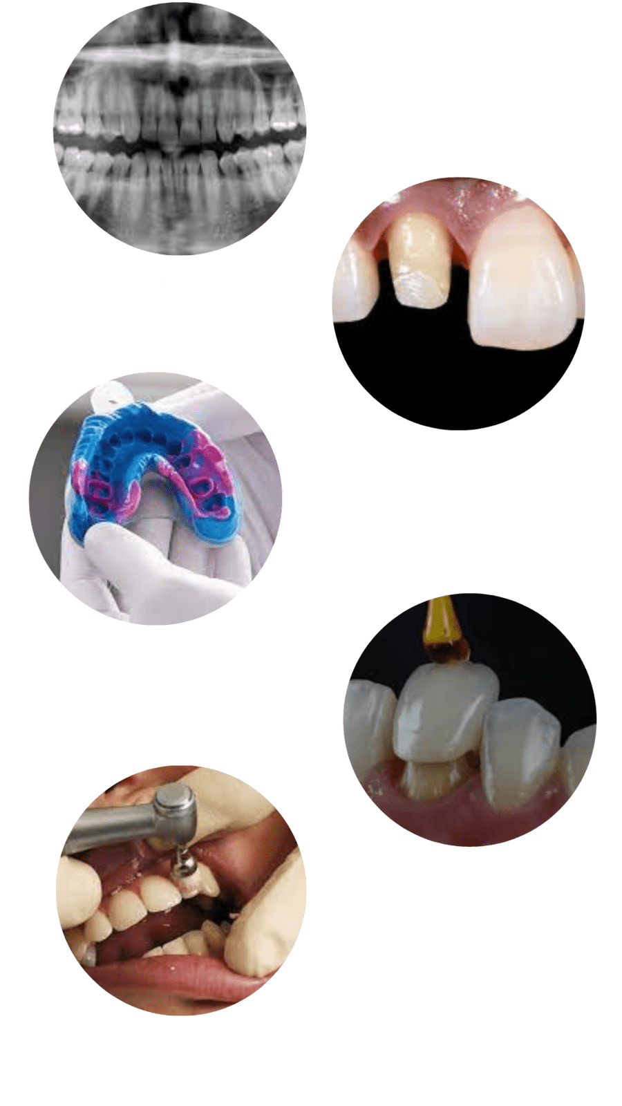 Steps for placing a dental crown.
