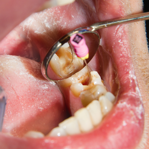 Tooth undergoing root canal treatment in progress.