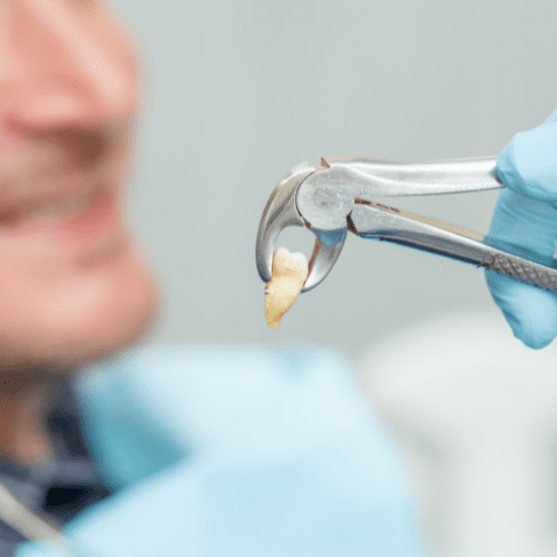 Forceps holding an extracted tooth.