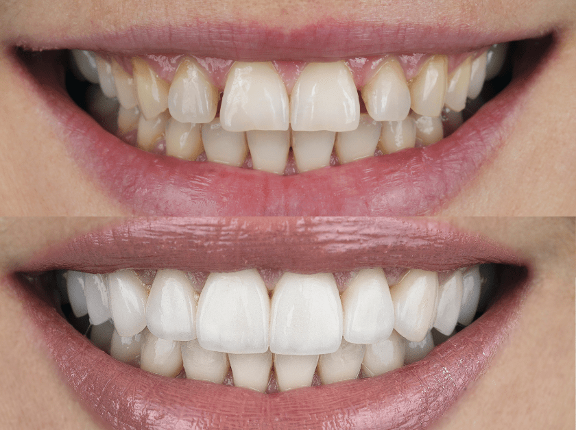 Smile with yellow and white teeth.