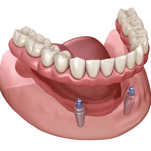 Snap-on denture over 2 implants.