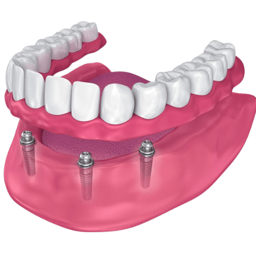 Semi-removable dentures on 3 implants snap-on implants.