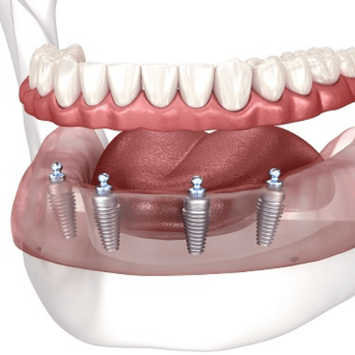Semi-removable dentures on 4 implants snap-on implants.
