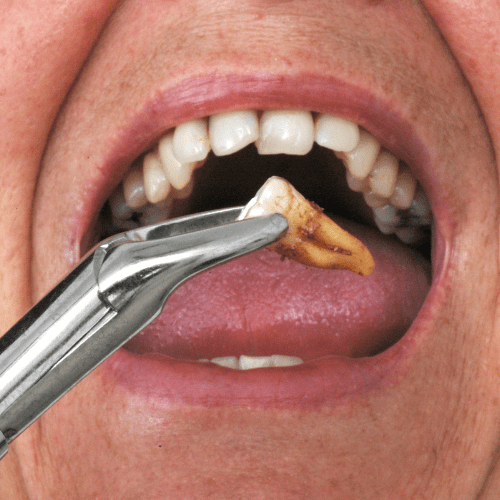 Forceps gripping an extracted tooth in a surgical procedure.