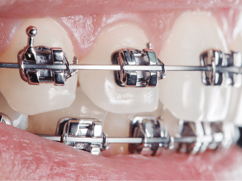 Teeth with self-ligating braces.