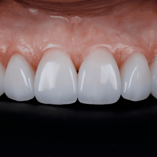 Dentist assessing a patient for Zirconia crowns