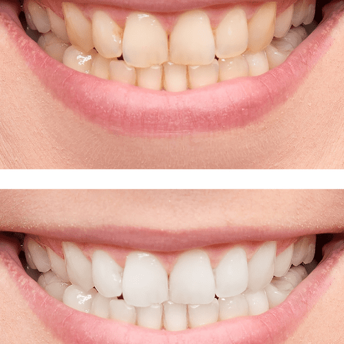 Smile comparison after teeth whitening.