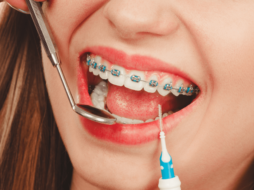 Open-mouth patient under braces examination.