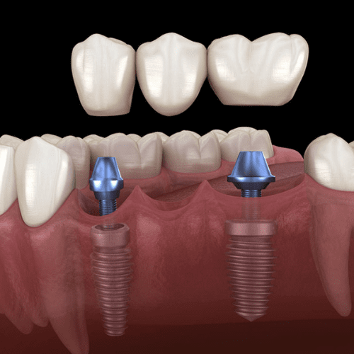 Three-tooth dental bridge on implants.