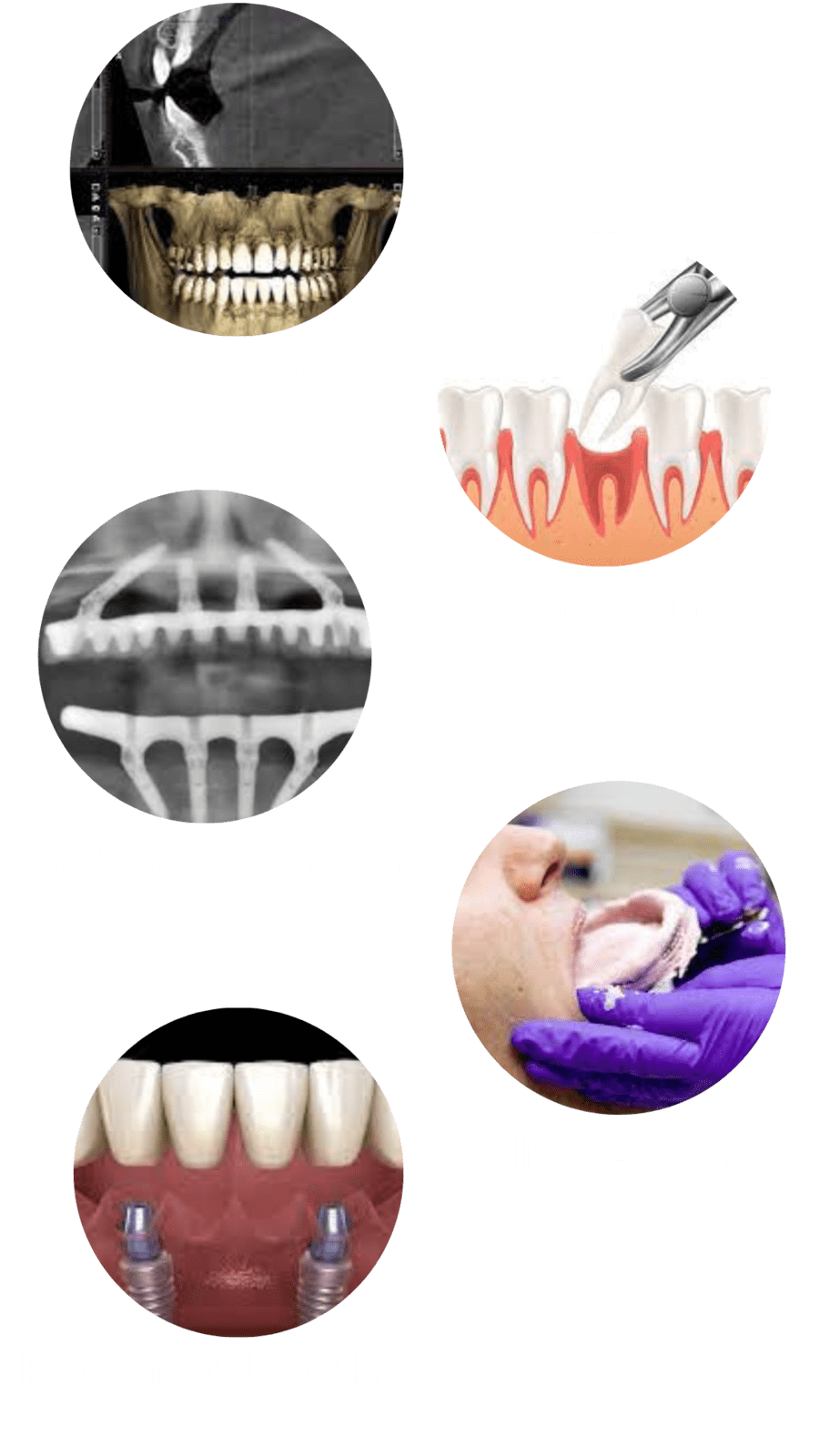 Process flow for all on 4 fixed denture placement.