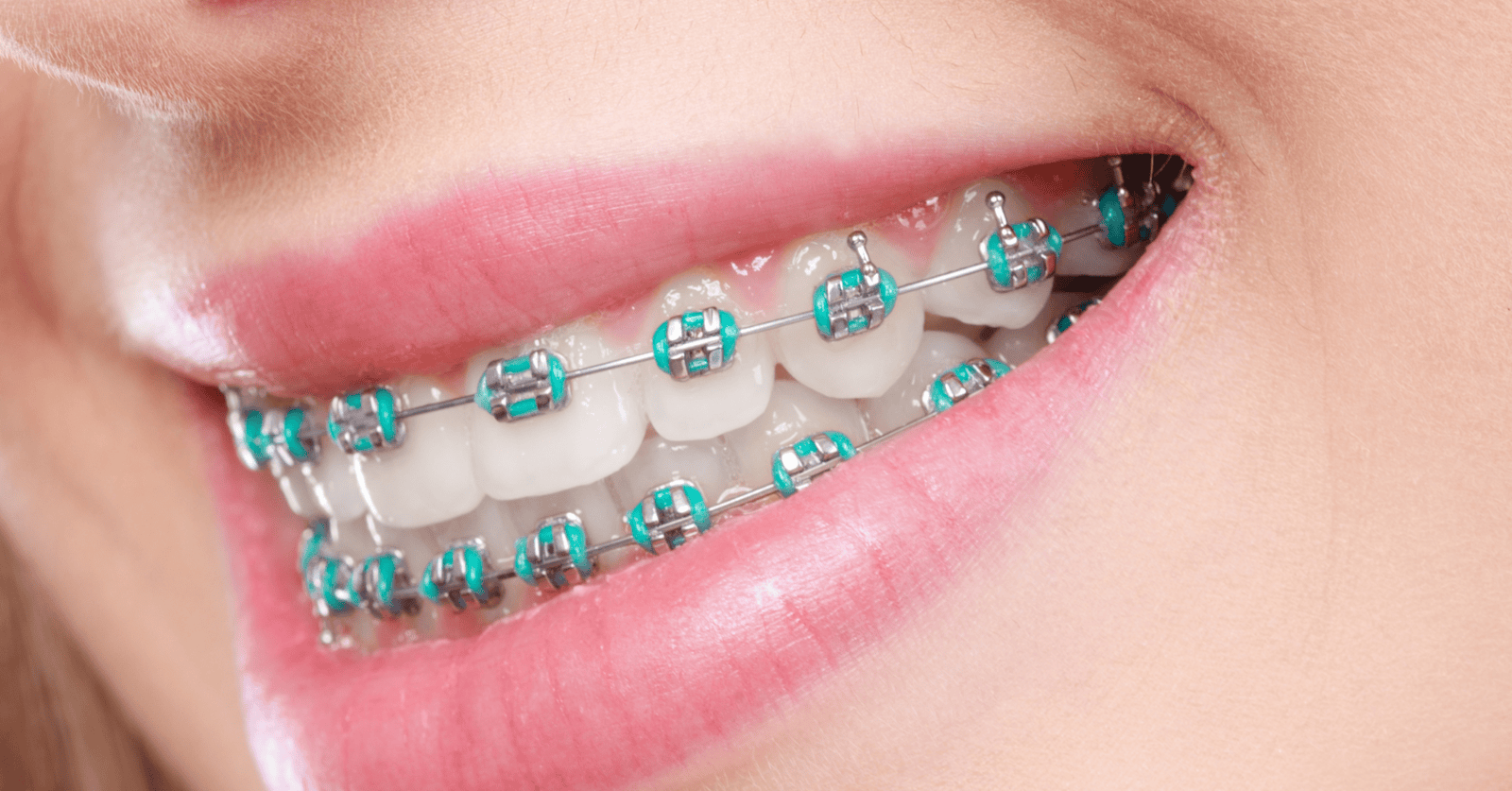 Smile with traditional Braces